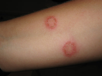 Ringworm: What Is It And How Do You Treat It?